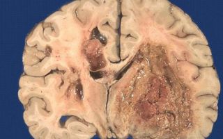 Глиома мозга: фото, прогноз, выживаемость