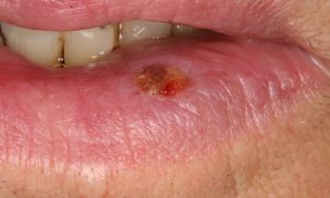 Рак губы начальная стадия – описание, лечение, фото
