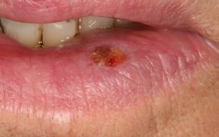Рак губы начальная стадия – описание, лечение, фото