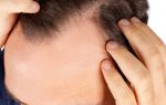Рак волос – описание, инновационное лечение