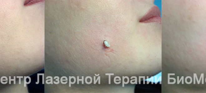 Злокачественные родинки: фото и описание