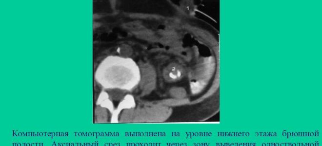 Питание при раке кишки: прямой, толстой, сигмовидной