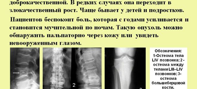 Опухоли костной ткани: виды, описание, прогноз