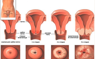 Рак матки 2 стадии