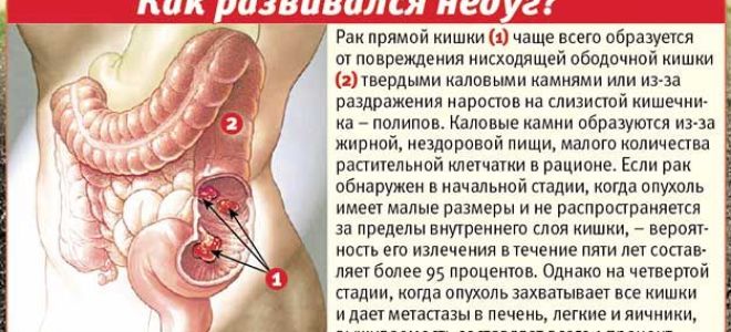 Ранние симптомы рака кишечника: список