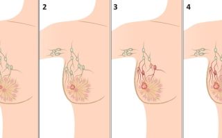 Стадии рака грудины у женщин