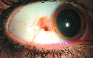 Как выглядит рак глаза? фото и прогноз