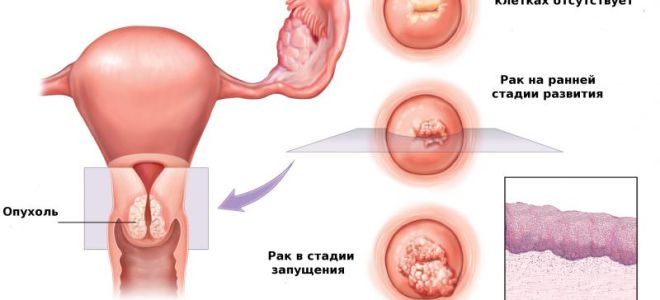 Я хочу жить! у меня рак крови!