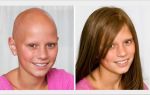 Восстановление волос после химиотерапии: 4 главных правила
