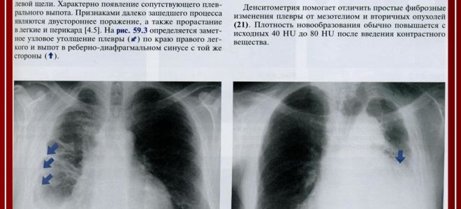 Рак нижней губы – начальная стадия. фото и описание