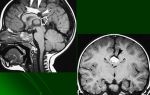 Липома мозга: лечение, фото, прогноз