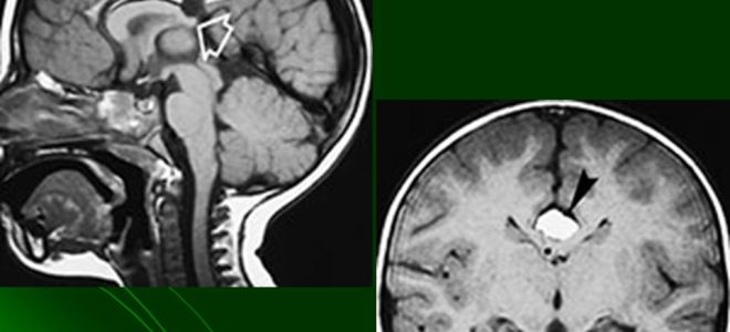 Липома мозга: лечение, фото, прогноз