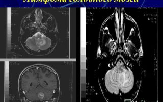 Лимфома мозга: признаки, диагностика, лечение, фото