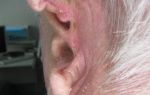 Рак уха: как распознать и предотвратить? фото