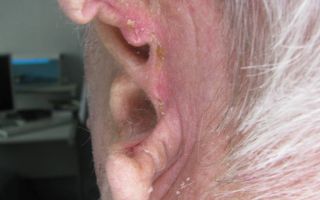 Рак уха: как распознать и предотвратить? фото
