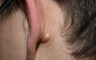 Рак ушей: причины, симптомы, лечение, прогноз