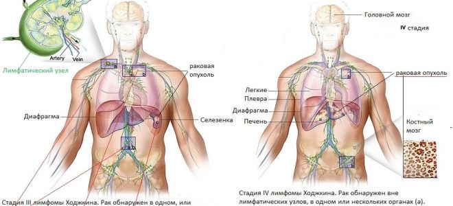 Лечение лимфомы ходжкина в израиле