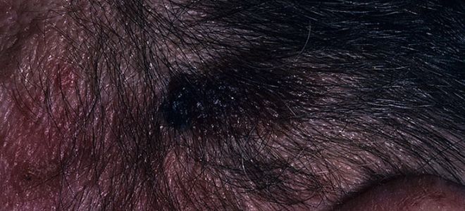 Что вызывает рак мозга?