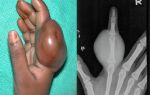 Саркома кости: фото, прогноз и выживаемость