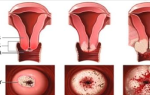 Рак матки 3 стадии