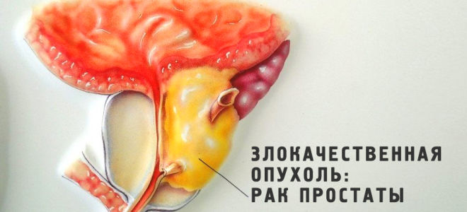 Рецидив рака простаты. причины, признаки, лечение и прогноз