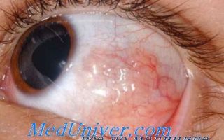 Абдаллах1 (рак обоих глаз, двусторонняя ретинобластома)
