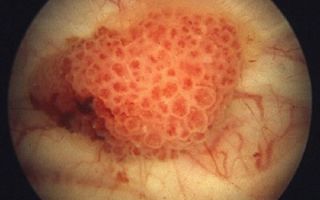 Рак мочевого пузыря. прогноз и как продлить жизнь?