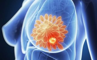 Рак молочной железы: продолжительность жизни