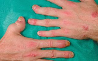 Рак пальца – причины, симптомы, лечение
