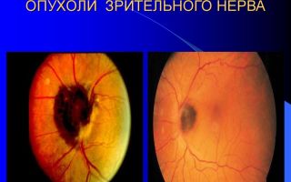 Опухоли зрительного нерва: классификация, фото