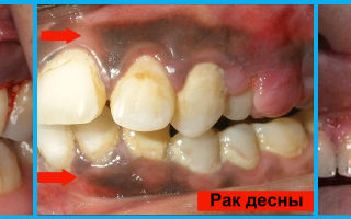 Рак зуба – описание, лечение, симптомы, фото