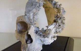 Как выглядит опухоль черепа? фото и описание