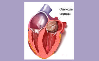 Опухоль сердца (рак сердца) – новейшие методики лечения