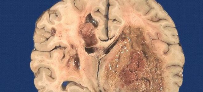 Доброкачественная опухоль мозга: фото, виды, прогноз