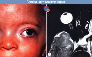 Глиома зрительного нерва. фото, последствия и прогноз