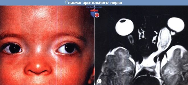 Глиома зрительного нерва. фото, последствия и прогноз
