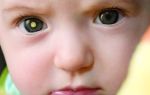 Рак глаз у детей