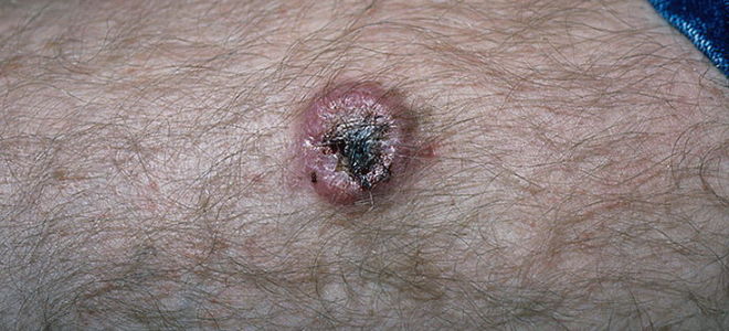 Дерматофибросаркома. фото, прогноз, профилактика