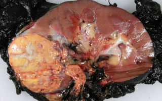Раковая опухоль. фото злокачественных опухолей