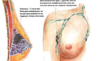 Рецидив рака молочной железы: главные признаки