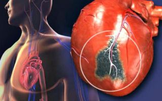 Рак сердца – как распознать, предотвратить?