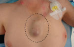 Рак грудины у женщин: фото и описание