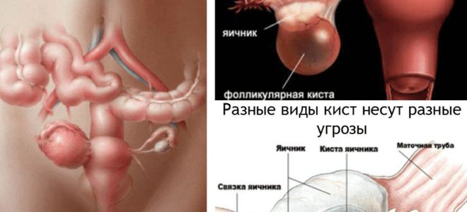 Киста правого яичника