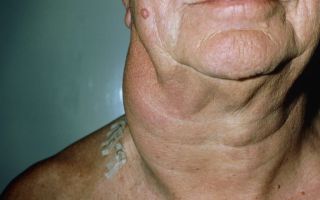Рак шеи – признаки, фото, лечение