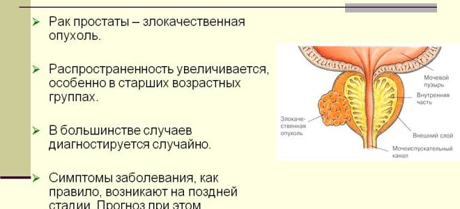 Рак простаты – прогноз, чего ожидать?