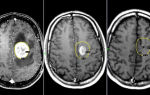 Опухоль мозга у ребенка: 11 явных признаков