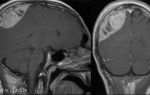 Саркома мозга: сколько осталось жить? фото