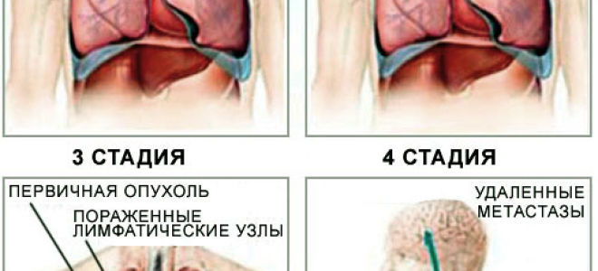 Рак легких метастазы – сколько живут?