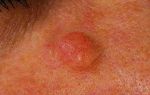 Рак кожи на лице: фото и ранние признаки