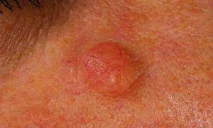 Рак кожи на лице: фото и ранние признаки
